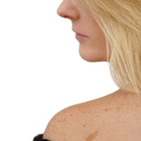 Назрела необходимость обновления клинических рекомендаций по скрининговым осмотрам по выявлению меланомного рака кожи