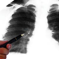 Затверджено нову редакцію клінічного протоколу медичної допомоги хворим на туберкульоз