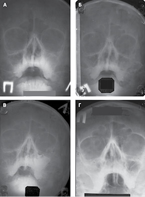  Дані рентгенограм кісток лицьового черепа пацієнтки Н., отримані протягом хвороби