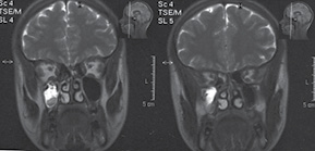  Магнітно-резонансна картина змішаного бактеріально-грибкового правобічного гаймориту у пацієнтки Н.