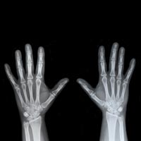 Остеопороз — болезнь, которая грозит не только женщинам