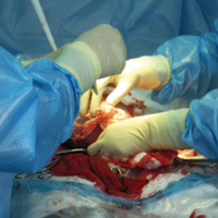 Выявлены особенности применения  операции Уиппла у людей пожилого возраста