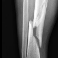 Наличие экземы у взрослого человека повышает риск перелома разной локализации