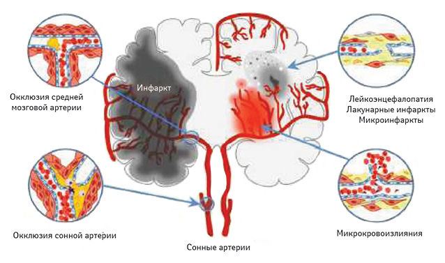  Поражения мозга, связанные с АГ (адаптировано по: Faraco G., Iadecola C., 2013)