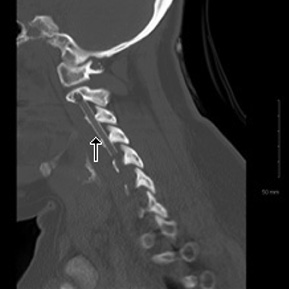  Sagittal CT image of the cervical region demonstrates a left vertebral artery stent (arrow) extending from the C