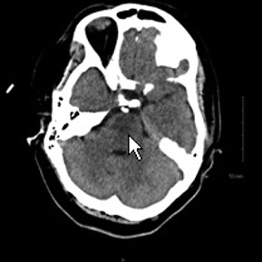  Axial CT image through the Pons shows a zone of low attenuation (arrow) eccentric to the right within the Pons suspicious for a pontine infarct
