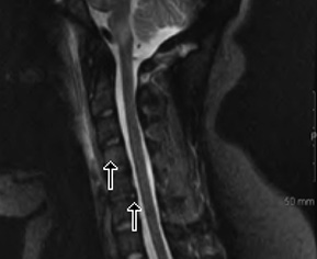  Midline sagittal STIR image of the cervical spine demonstrates increased signal in the posterior annulus at C