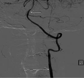  Cerebral angiography image from a left vertebral artery injection demonstrates a patent left vertebral artery and basilar artery with arrows denoting the left vertebrobasilar stents
