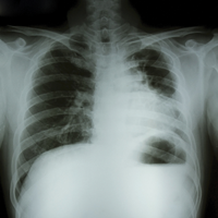 Идентифицированы гены, ассоциированные с развитием бронхиальной астмы и аллергических заболеваний