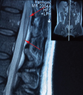  МРТ-картина попереково-крижового мієліту у пацієнта В. (вогнище ураження позначено стрілками)