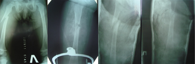  Пацієнт М., 2 роки. Лікування ПСК методом скелетного витягнення та фіксаційним методом