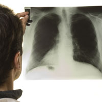 Пассивное курение сильно повышает риск развития туберкулеза