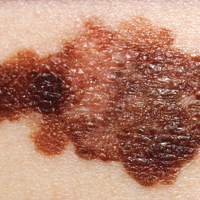 Трансплантация органов связана с повышенным риском распространенной меланомы