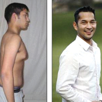 Физиологическая гинекомастия у парней: в чем причина?