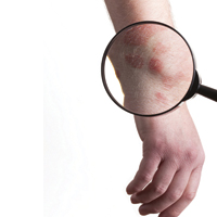 Количество родинок на правой руке может прогнозировать риск возникновения рака кожи