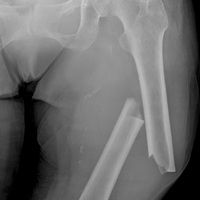 Хирургическое лечение при ожирении повышает риск переломов костей