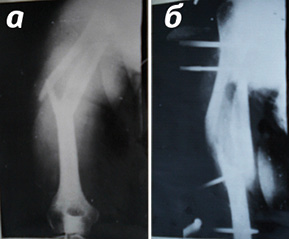 Фотоотпечатки рентгенограмм пациентки Г., 74 года: