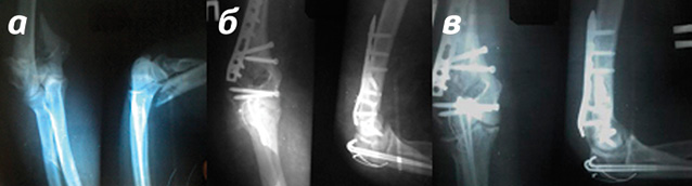  Фотоотпечатки рентгенограмм пациентки Б., 51 год: 
