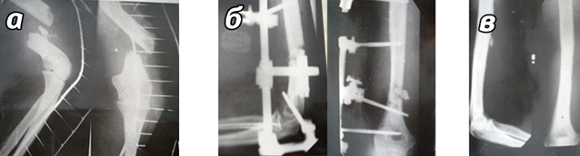  Фотоотпечатки рентгенограмм пациента Д., 29 лет: 