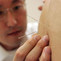 Акупунктура не способна улучшить качество жизни женщин в период менопаузы