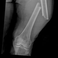 Переохлаждение во время операции связано с повышенным риском развития инфекционных осложнений