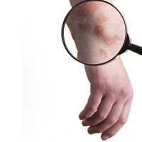 Установлена связь между тяжелыми формами псориаза и повышенным риском разрыва брюшного отдела аорты