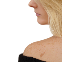 Актуально для лета: кому следует остерегаться развития меланомы?