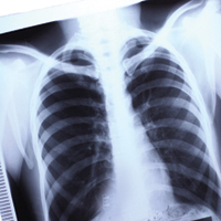 У Києві відбувся семінар з протидії туберкульозу