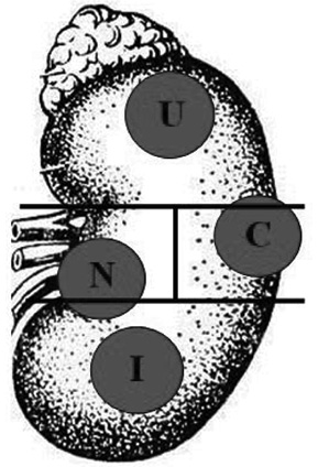  Позначення сегментів розміщення пухлини в нирці (варіант 1): U — повністю у верхньому; I — повністю у нижньому; N — 90% у медіальному; C — 95% у латеральному