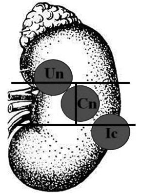  Позначення сегментів розміщення пухлини в нирці (варіант 2): Un — більша частина (80%) у верхньому, менша (20%) — у медіальному сегменті; Ic — більша частина (75%) у нижньому, менша (25%) — у латеральному сегменті; Cn — більша частина (60%) у латеральному, менша (40%) — у медіальному сегменті