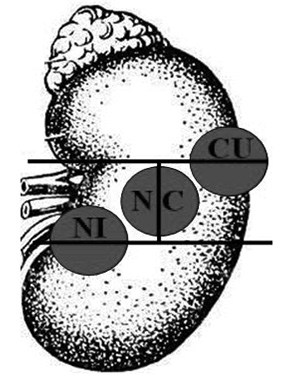  Позначення сегментів розміщення пухлини в нирці (варіант 3): CU — порівну в латеральному та верхньому сегменті; NI — порівну в медіальному та нижньому сегменті; NC — порівну в медіальному та латеральному сегменті