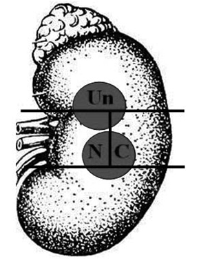  Позначення сегментів розміщення пухлини в нирці (варіант 4): Un — більша частина (60%) у верхньому, менша (30%) — в медіальному та 10% — в латеральному сегменті; NC — порівну (45%) в медіальному та латеральному сегментах, а 10% — у нижньому сегменті