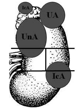  Позначення сегментів розміщення пухлини в нирці (варіант 5): UnА — більша частина у верхньому (U), менша — в медіальному (n) сегменті з підростанням до надниркової залози (A); UA — у верхньому (U) сегменті з проростанням у надниркову залозу (A); IcA — більша частина у нижньому (I), менша — в медіальному (C) сегменті з метастатичним ураженням надниркової залози (А)