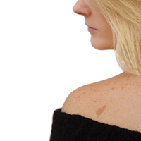 Кто, кроме людей с рыжими волосами, подвержен более высокому риску развития рака кожи?