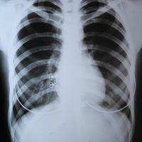 Україна переходить до лікування туберкульозу поза стаціонарами