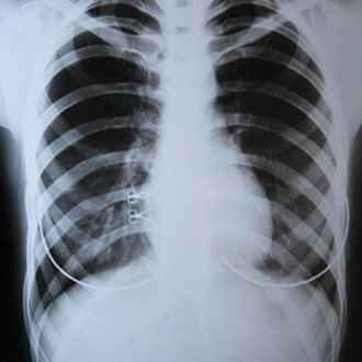 Туберкульоз в Україні: акцент на амбулаторне лікування