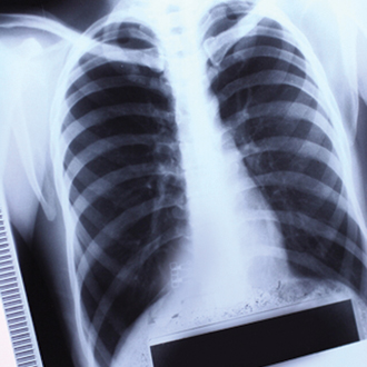 Обстеження киян на пересувних флюорографах продовжено до 21 квітня 2017 р.